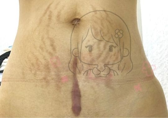 画像あり ケロイドになった帝王切開の傷の経過 閲覧注意 かりんとママブログ 元看護師新米ママの知りたかったことまとめ