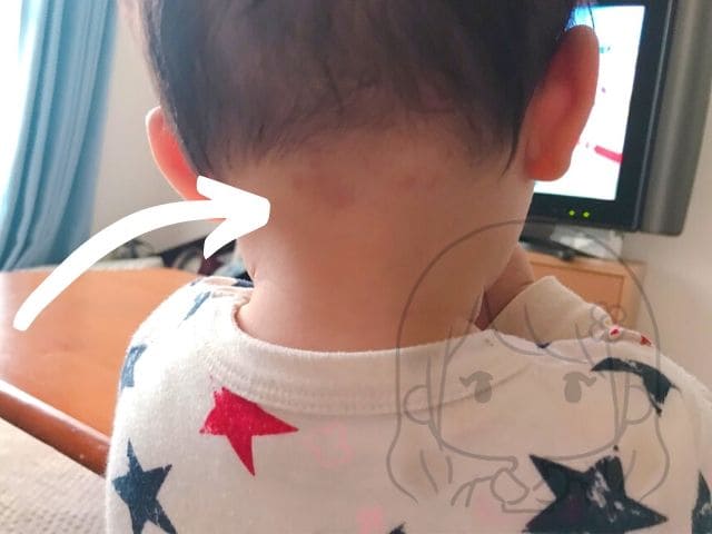 コウノトリの咬傷とは何ですか?