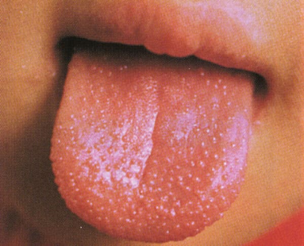 苺舌